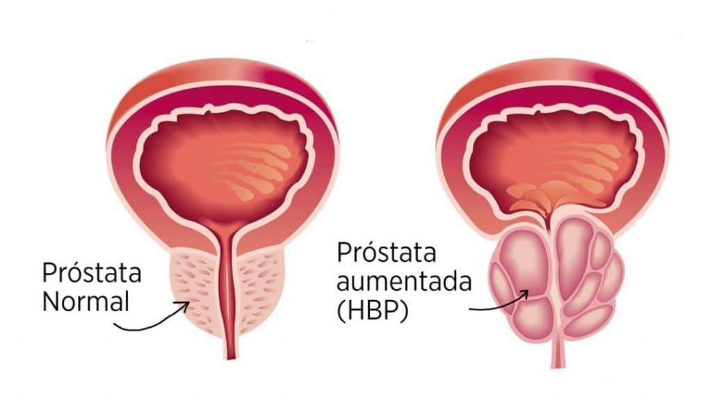 Doenças da Próstata